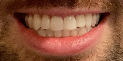 Bright smile after teeth whitening