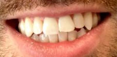 Yellow smile before teeth whitening