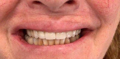 Bright smile after teeth whitening