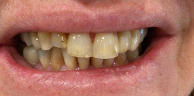 Yellow smile before teeth whitening