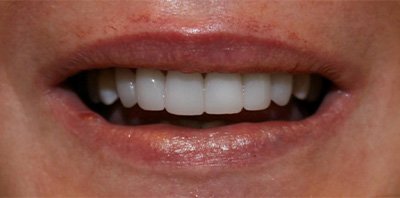 Bright smile after teeth whitening