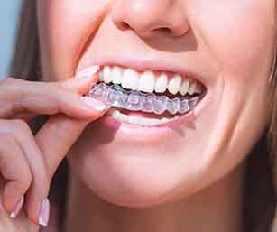 Nose-to-chin view of a woman with French tips inserting Invisalign