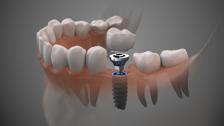 A computer image of a dental implant in a lower jaw.